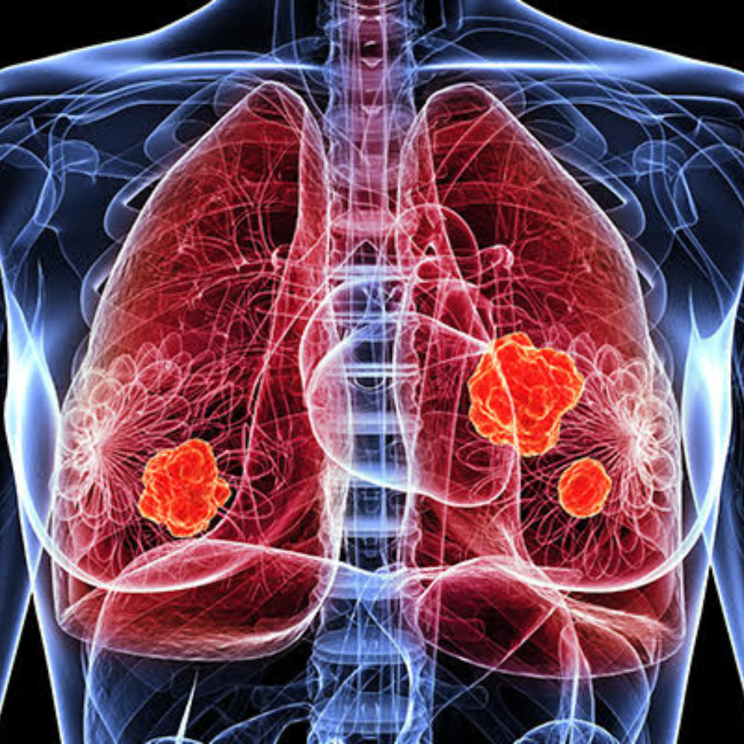 Impact of Irradiation Conditions on Therapy of Lewis Lung Carcinoma in Mice Using Glucose-Ethylenediamine Carbon Dots